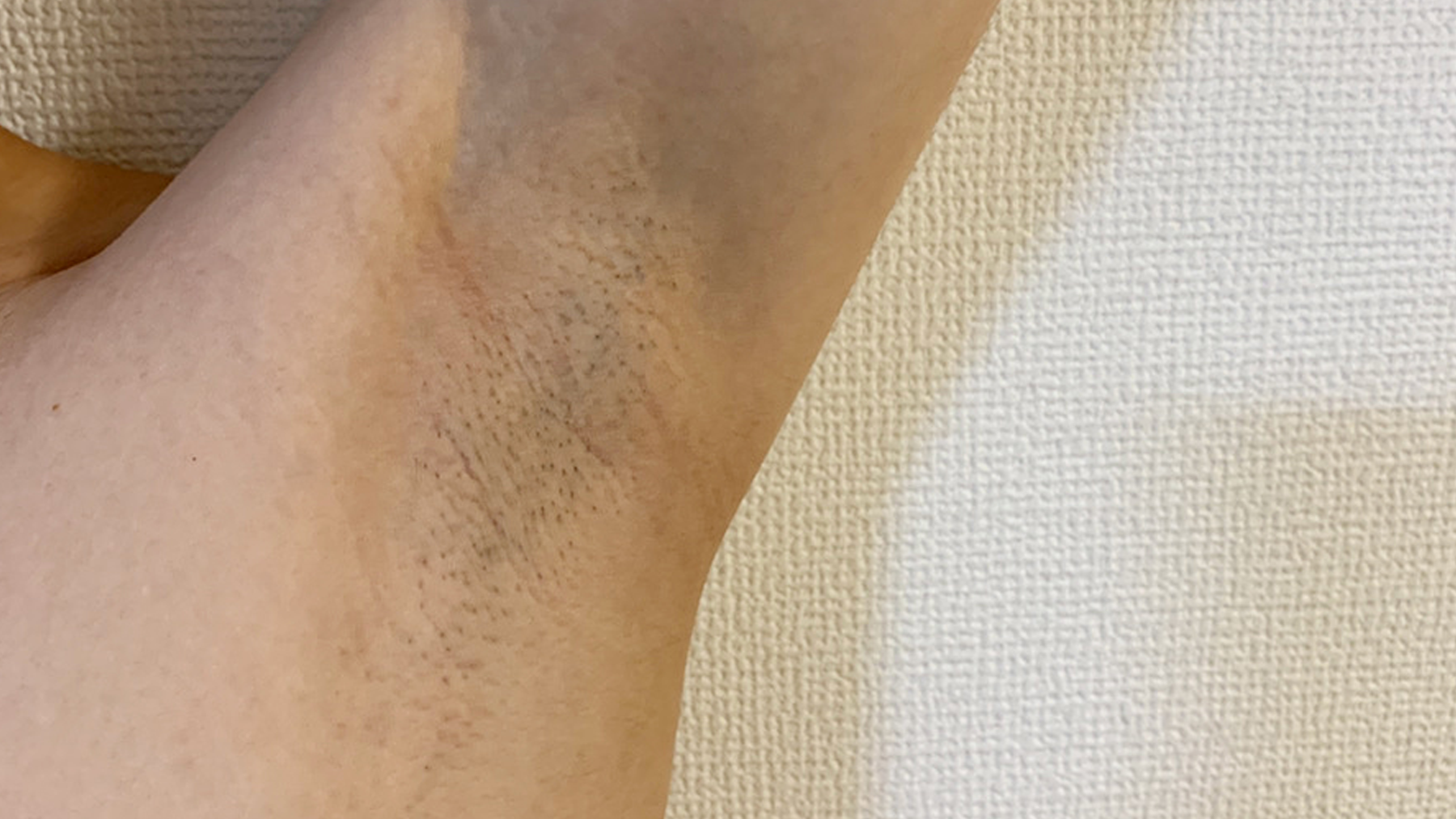 MIRAY-after-ipl-hair-removal
