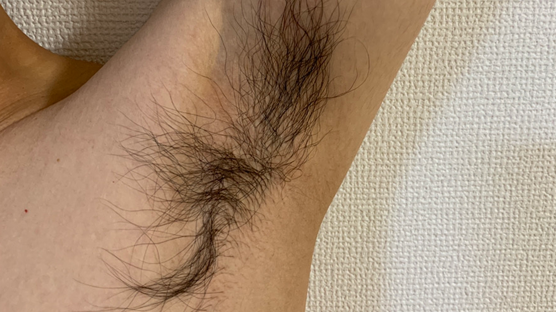 MIRAY-before-ipl-hair-removal