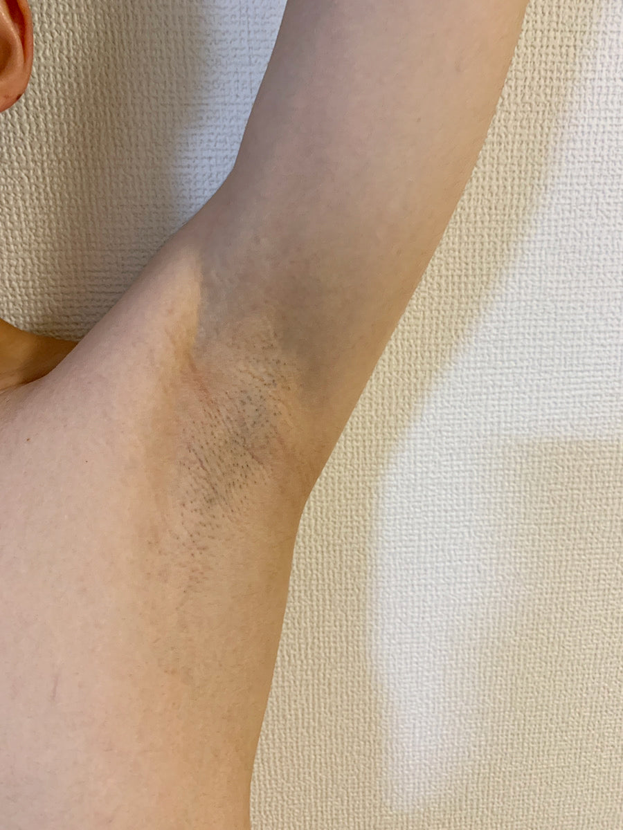 after-using-the-miray-ipl-hair-removal-for-two-weeks
