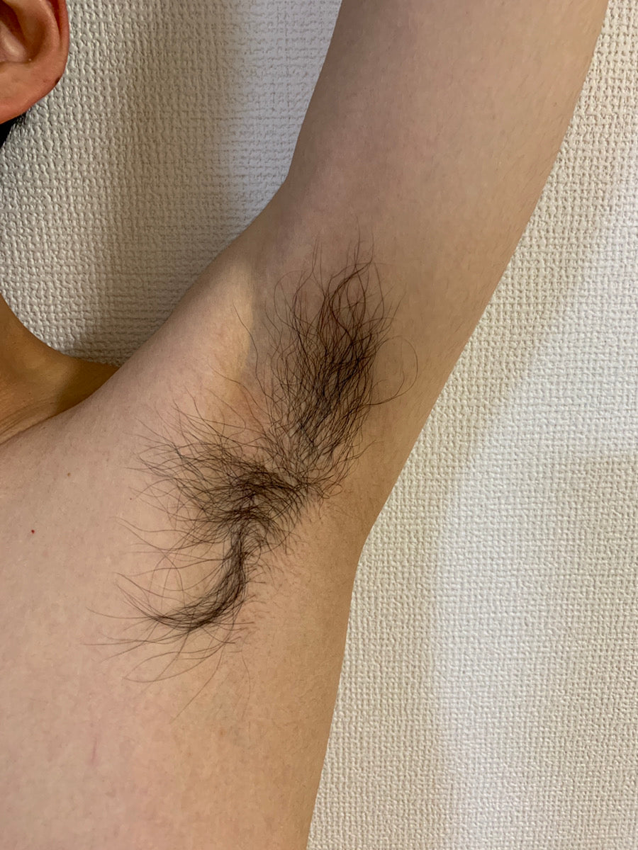 before-using-the-miray-ipl-hair-removal