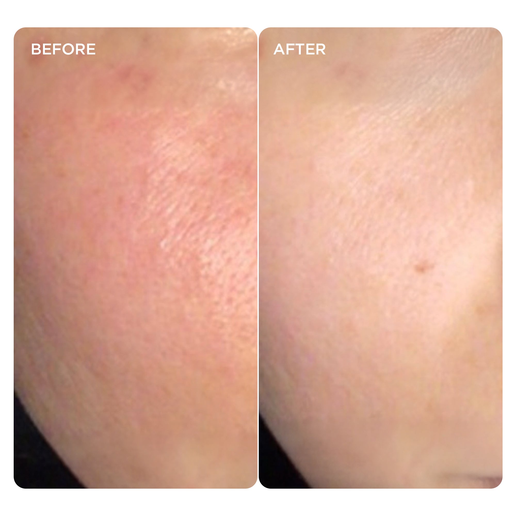 Skin after 4 weeks of DPL treatment