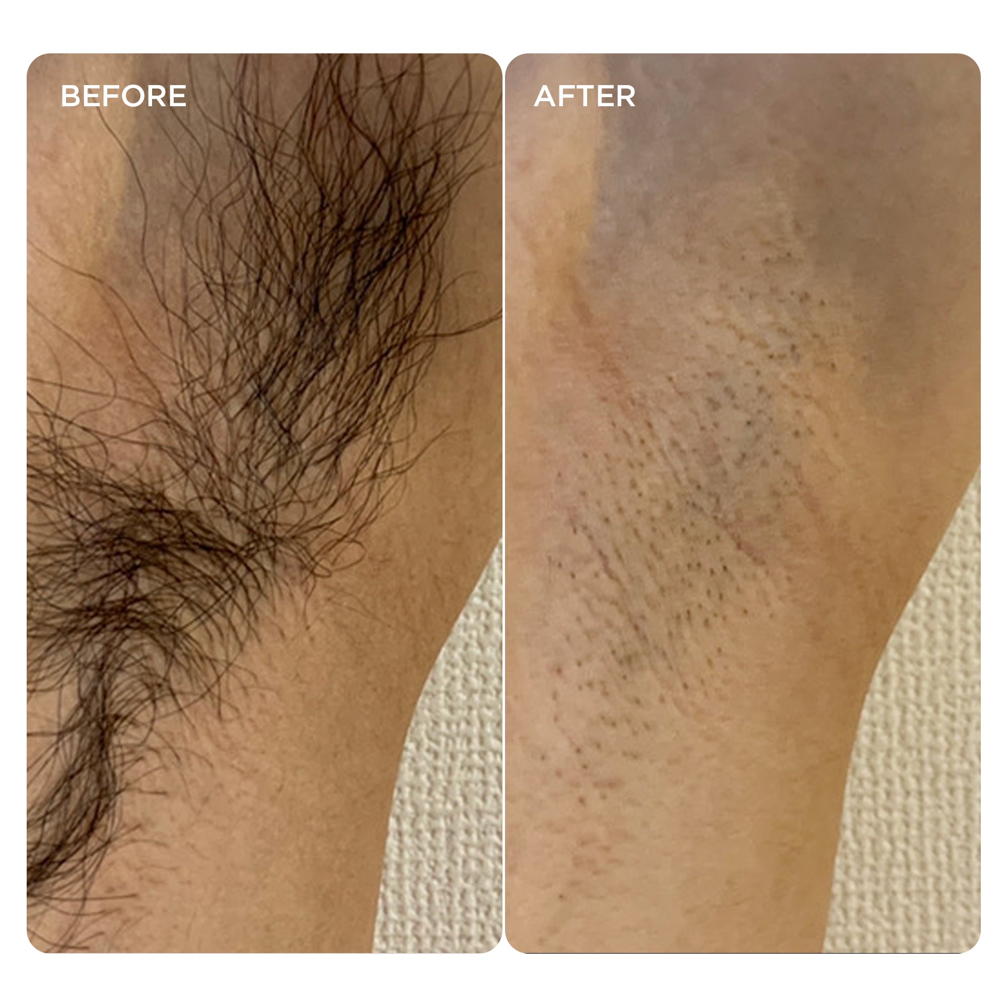 Skin after 2 weeks of IPL treatment