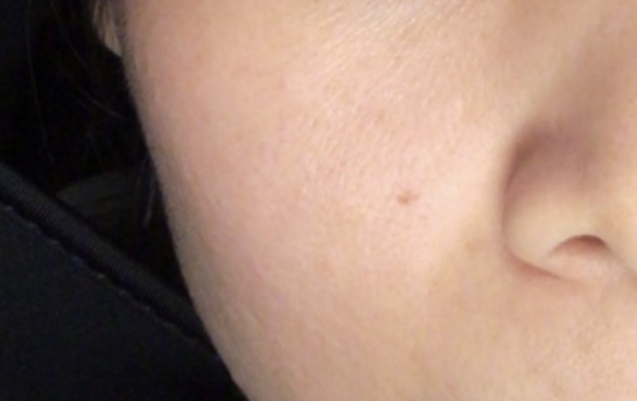 after-using-the-miray-dpl-skin-treatment
