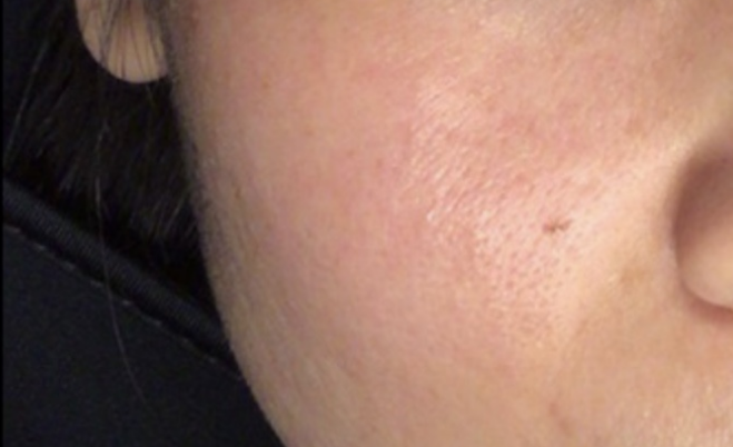 before-using-the-miray-dpl-skin-treatment